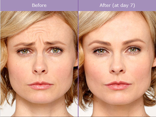 botox-dysport-brampton-cosmetic-before-after-female