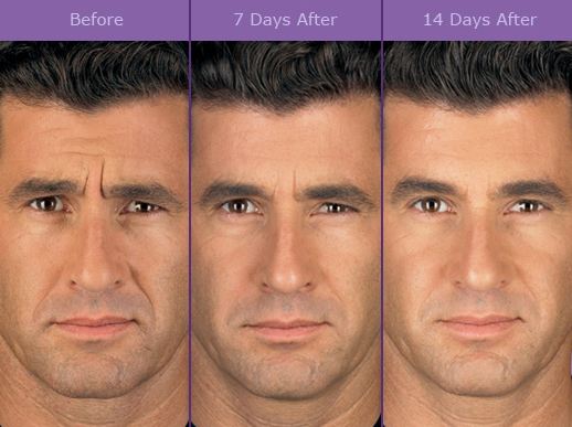 botox-dysport-brampton-cosmetic-before-after-male